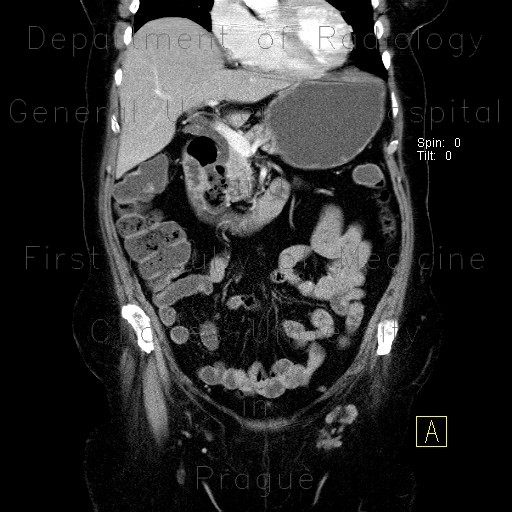 Diverticulum of duodenum