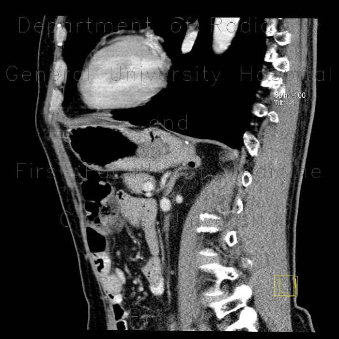 Radiology image - Diverticulum of stomach: Abdomen, Stomach: CT - Computed tomography