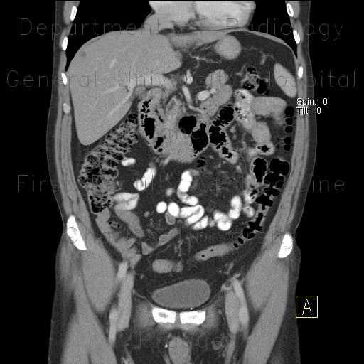 Duodenal diverticulum