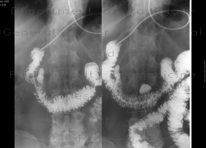 Duodenal diverticulum, large and multiple