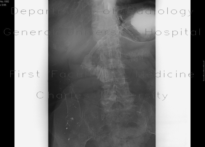 Radiology image - Duodenal stent, migration of stent: Abdomen, Small bowel: RF - Fluoroscopy