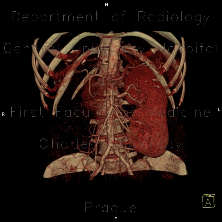 Duplex kidney