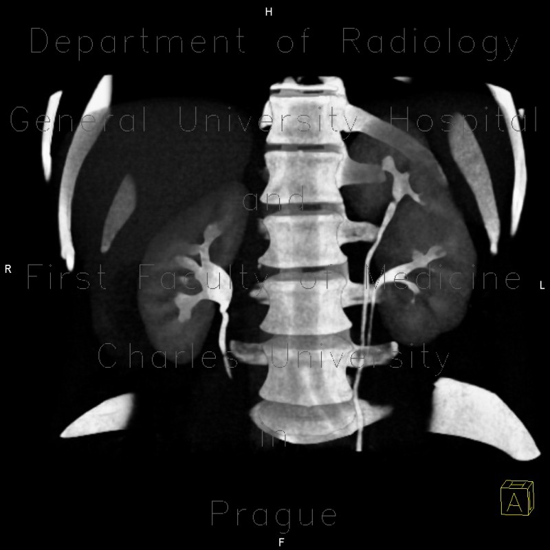 Duplication of collecting system of kidney, ureter fissus