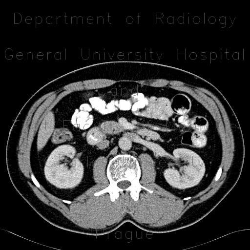 Duplication of inferior vena cava, VCI