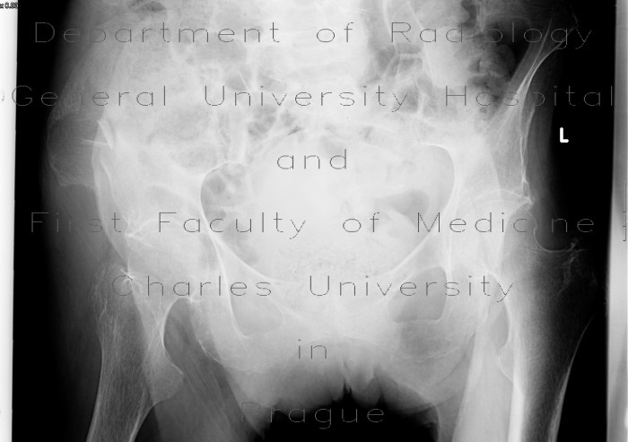 Duverney fracture, fracture of iliac wing