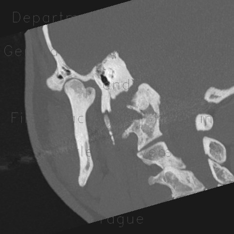 Dysplasia of head of mandible, bilateral