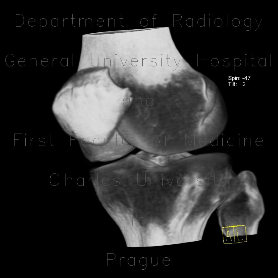 Dysplasia of patella, patellar dysplasia