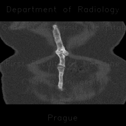 Dystrophic ossification in scar, linea alba, median laparotomy