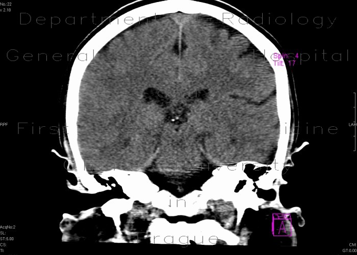 Early changes of brain ischemia, MCA