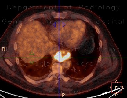 Ectopic pancreas, gigantic, pancreatic ectopia