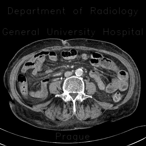 Radiology image - Edema of mesenteric fat in anasarca: Abdomen, Peritoneal cavity: CT - Computed tomography