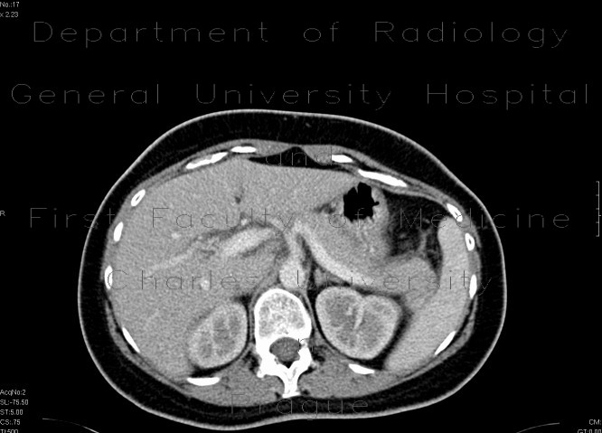 Radiology image - Edematous pancreatitis: Abdomen, Pancreas: CT - Computed tomography