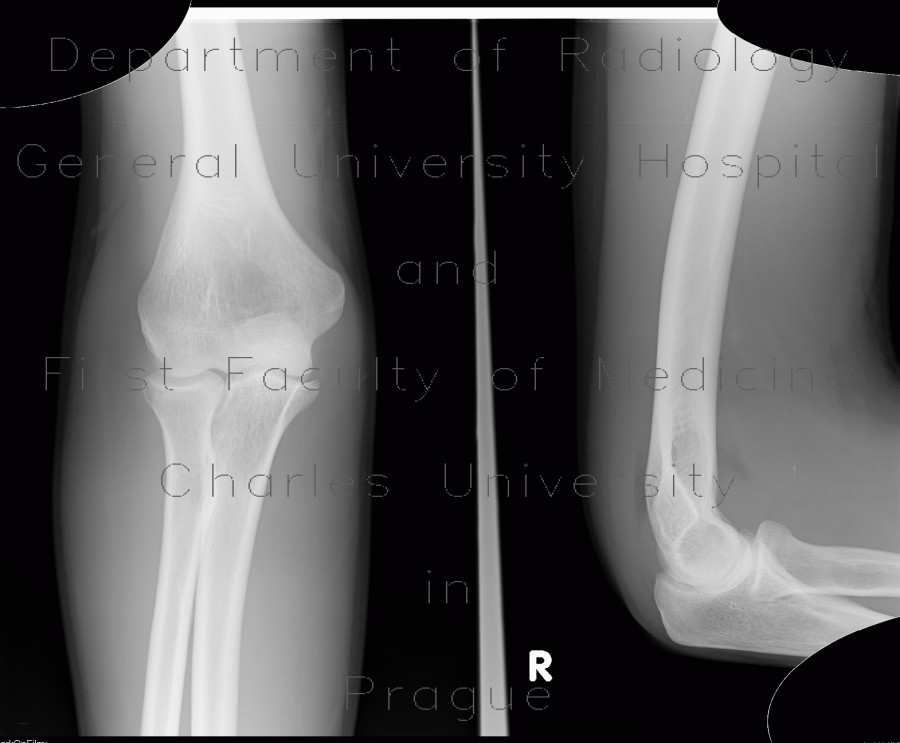 Radiology image - Effusion in elbow joint, sail sign, fracture of head of radius: Extremity, Bone, Soft tissue: X-ray - Plain radiograph