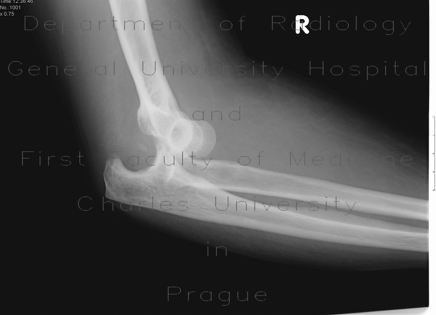 Radiology image - Elbow dislocation: Extremity, Bone: X-ray - Plain radiograph