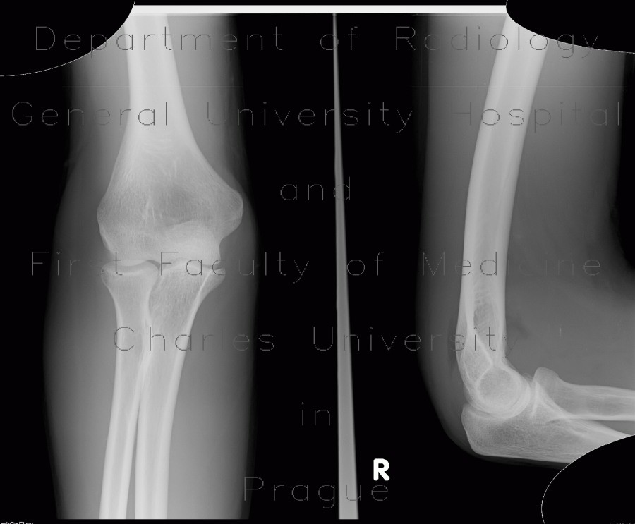 Radiology image - Elbow effusion, fat pad, sail sign: Extremity, Bone: X-ray - Plain radiograph