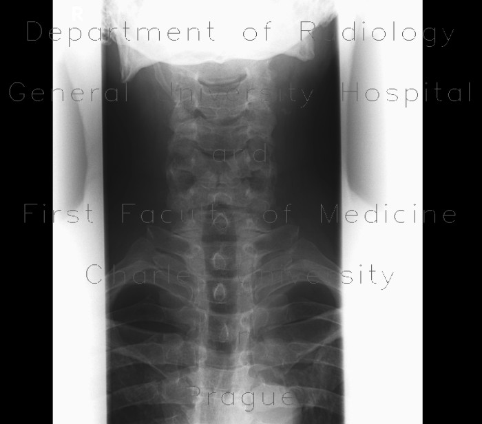 styloid process x ray