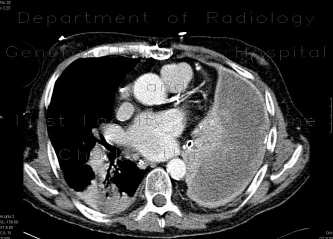 Empyema of the thorax