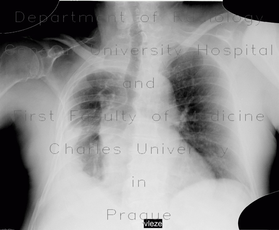 Radiology image - Empyema of thorax: Thorax, Lung, Mediastinum and pleural cavity: X-ray - Plain radiograph