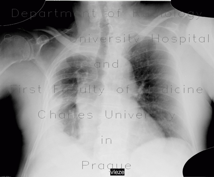 Empyema of thorax