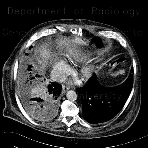 Radiology image - Empyema of thorax: Thorax, Lung, Mediastinum and pleural cavity: CT - Computed tomography