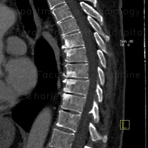 Radiology image - End plate disease, grade III, osteochondrosis, vacuum phenomenon: Spine and Axial, Bone: CT - Computed tomography