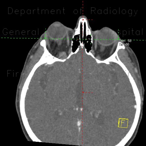 Endocrine orbitopathy, exophthalmus
