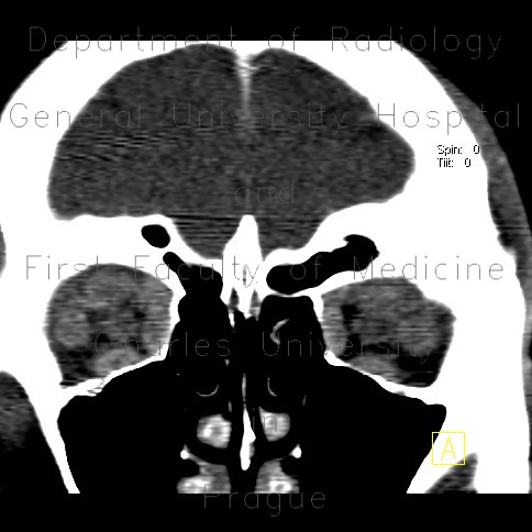 Endocrine orbitopathy, exophthalmus