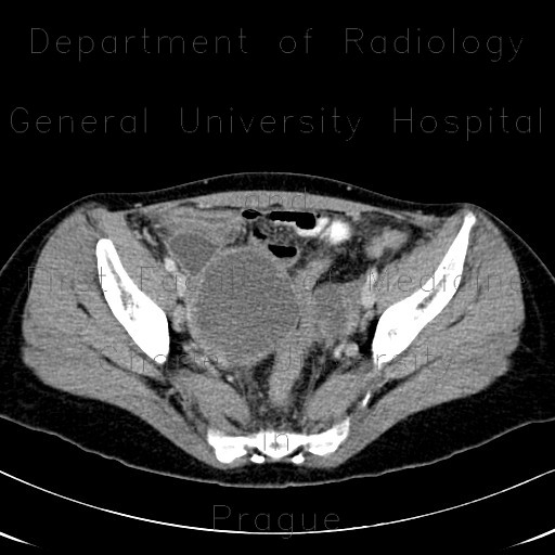 Radiology image - Endometriosis, ovarian endometriosis: Abdomen, Gynecology: CT - Computed tomography