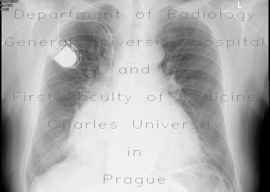 Radiology image - Enlarged heart: Thorax, Heart: X-ray - Plain radiograph
