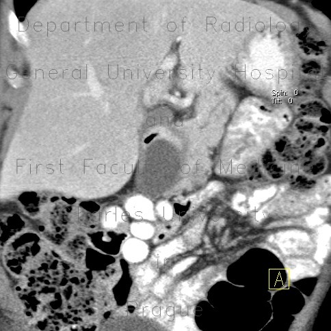 Radiology image - Enteric cyst of duodenum: Abdomen, Small bowel: CT - Computed tomography