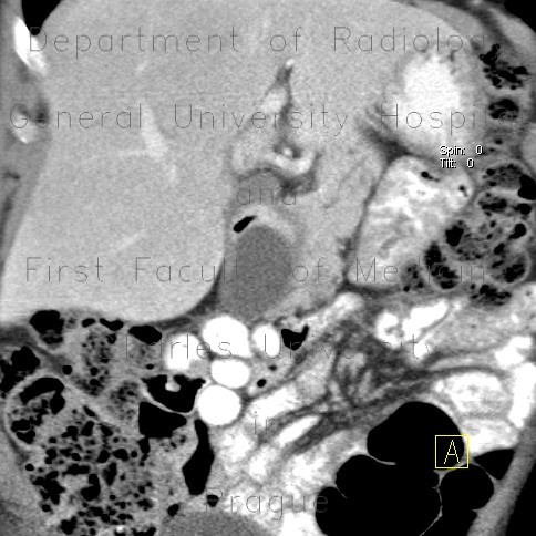 Enteric cyst of duodenum