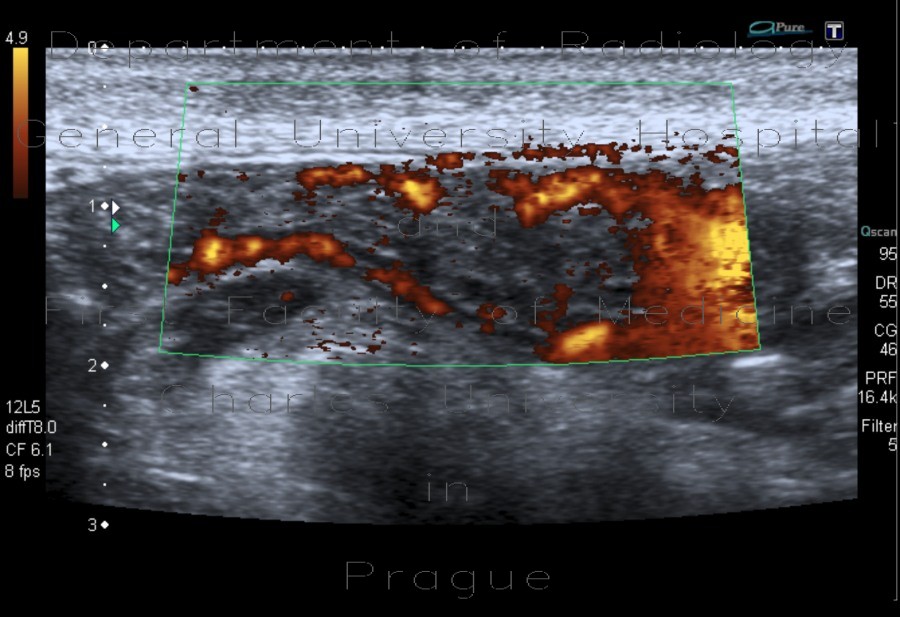 Enteritis, inflammation of small bowel
