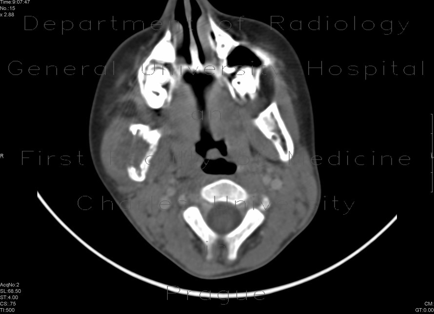 Eosinophilic granuloma of a bone