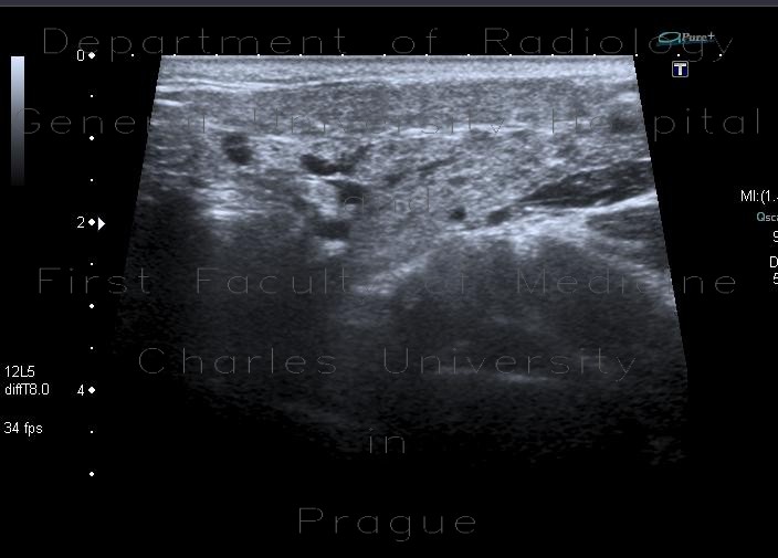 Radiology image - Epidemic parotitis: Head and Neck, Oral cavity: US - Ultrasound