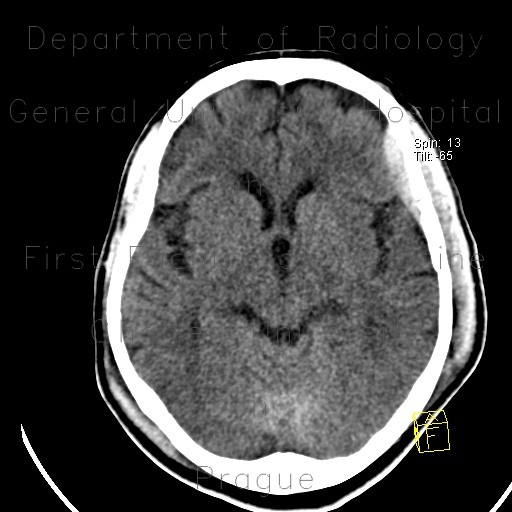 Epidural hematoma, subarachoid hemorrhage, cerebral contusion, skull fissure