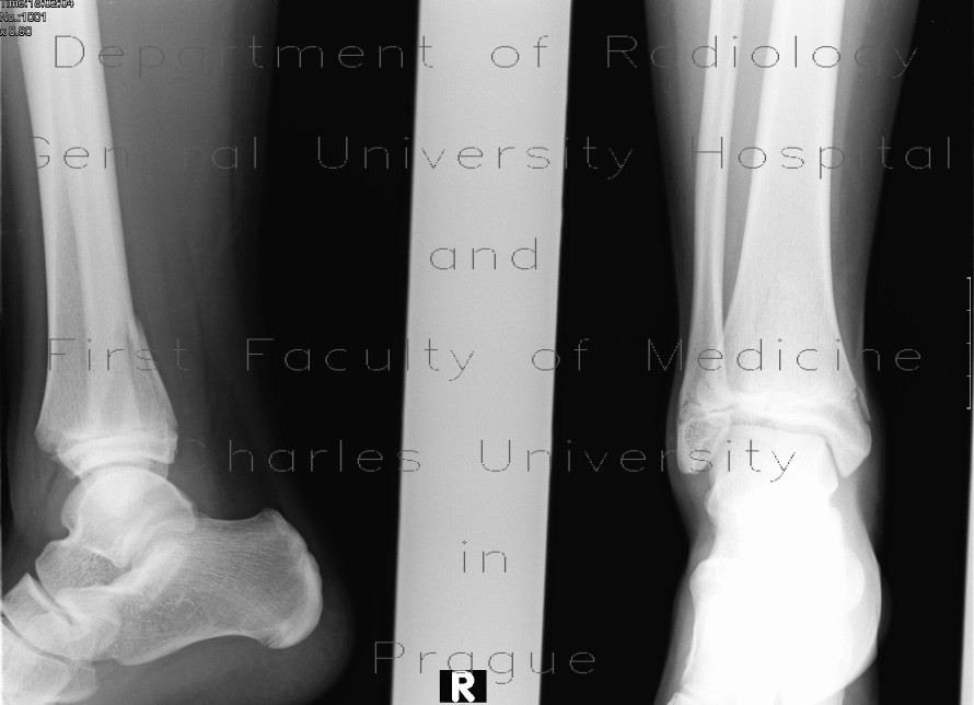Epiphyseal fracture of the posterior edge of tibia, Salter Harris II
