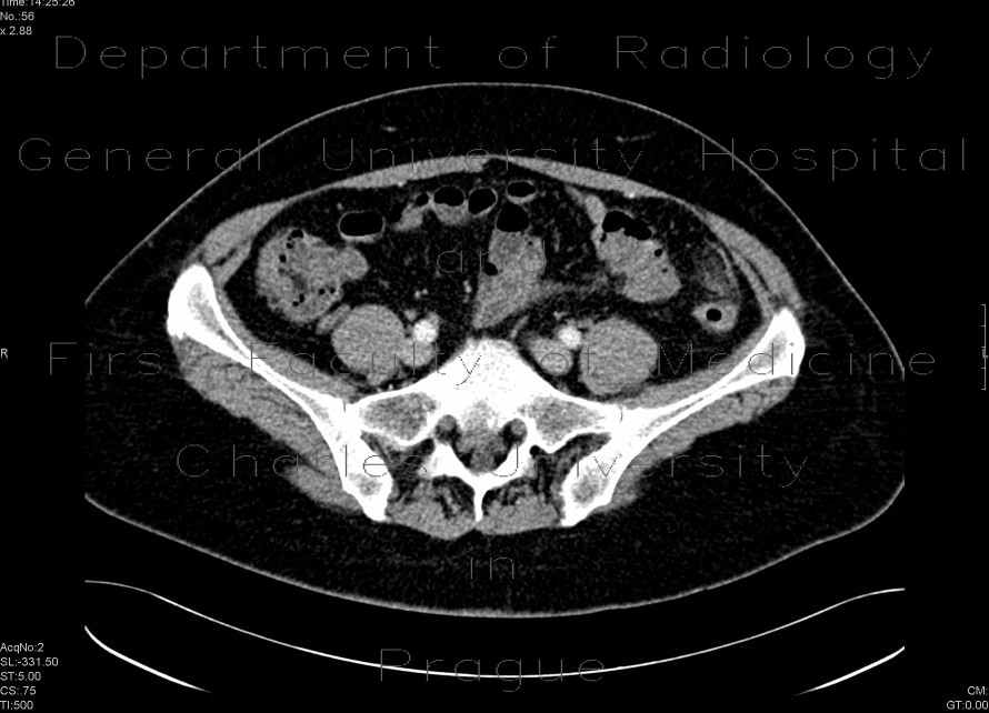 Epiploic appendagitis