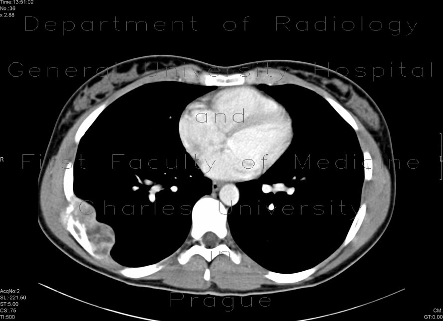 Radiology image - Ewing sarcoma of rib: Spine and Axial, Thorax, Bone: CT - Computed tomography
