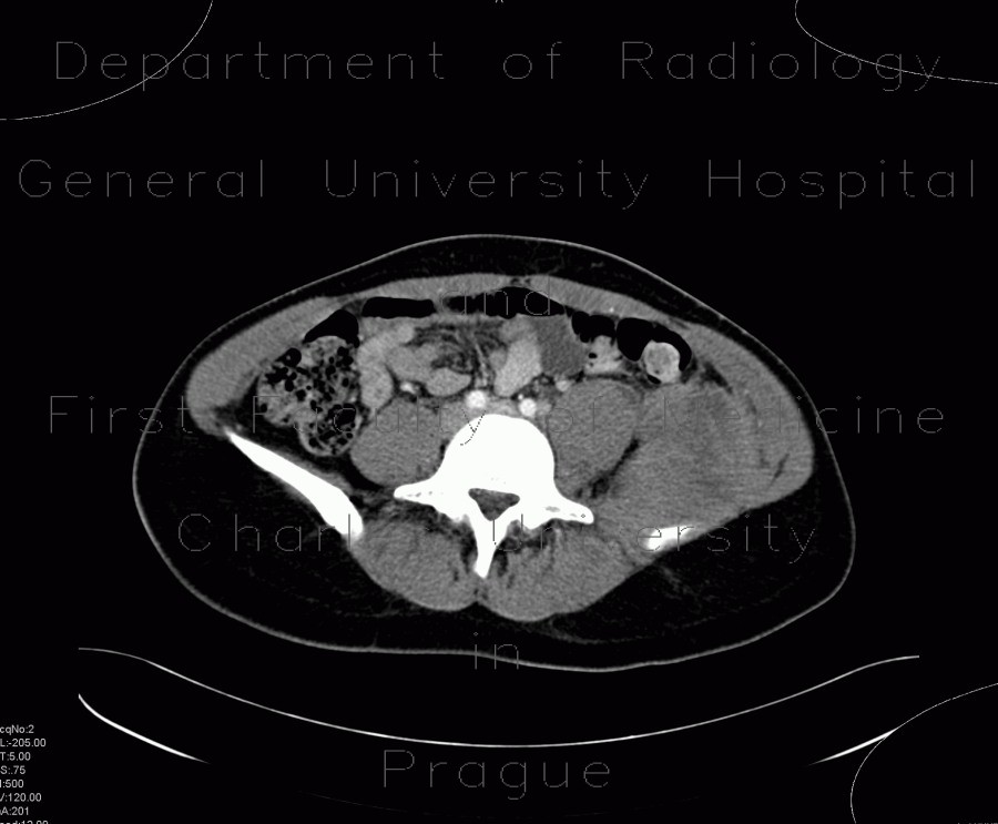 Ewing sarcoma, pelvis