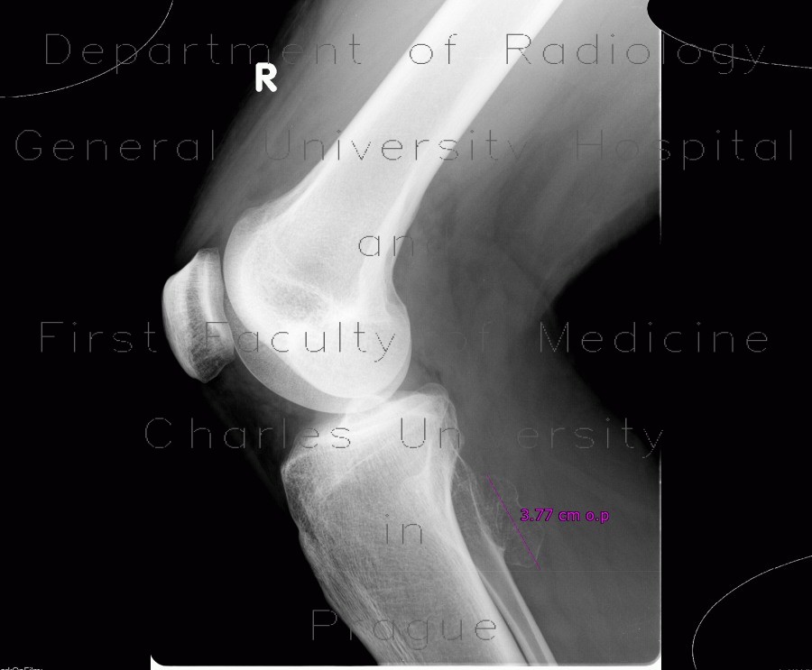Radiology image - Exostosis of fibula: Extremity, Bone: X-ray - Plain radiograph