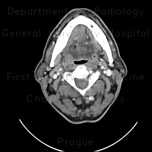 Expansion of right sublingual gland