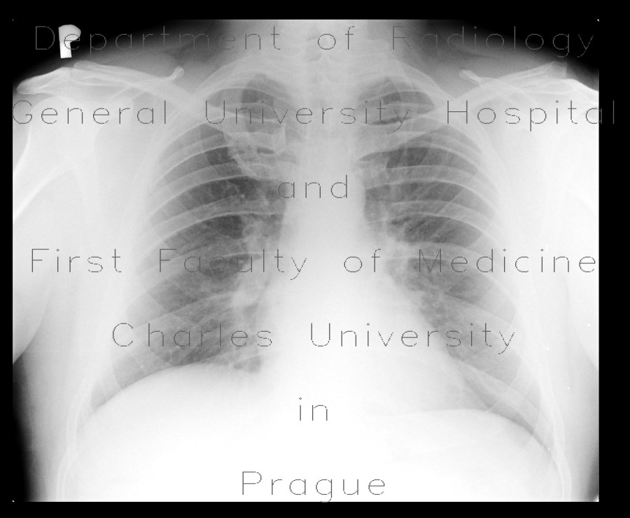Extensive pulmonary embolism and CT angiogram sign on chest radiograph