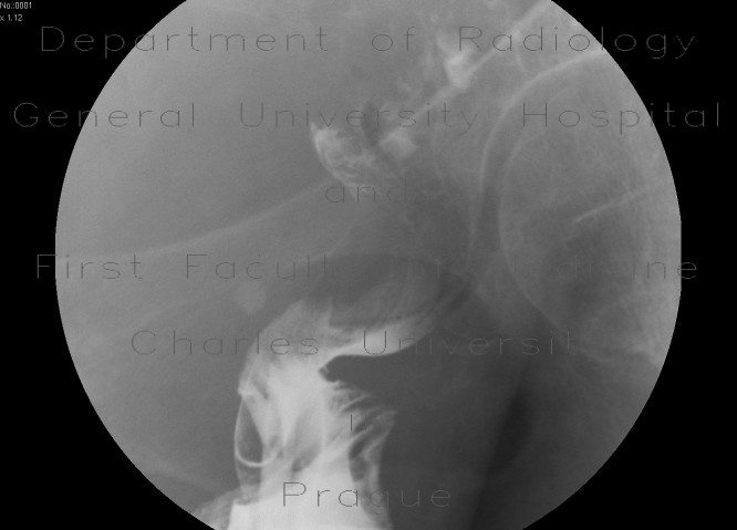 Radiology image - Extramural compresson of sigmoid colon: Abdomen, Large bowel: RF - Fluoroscopy