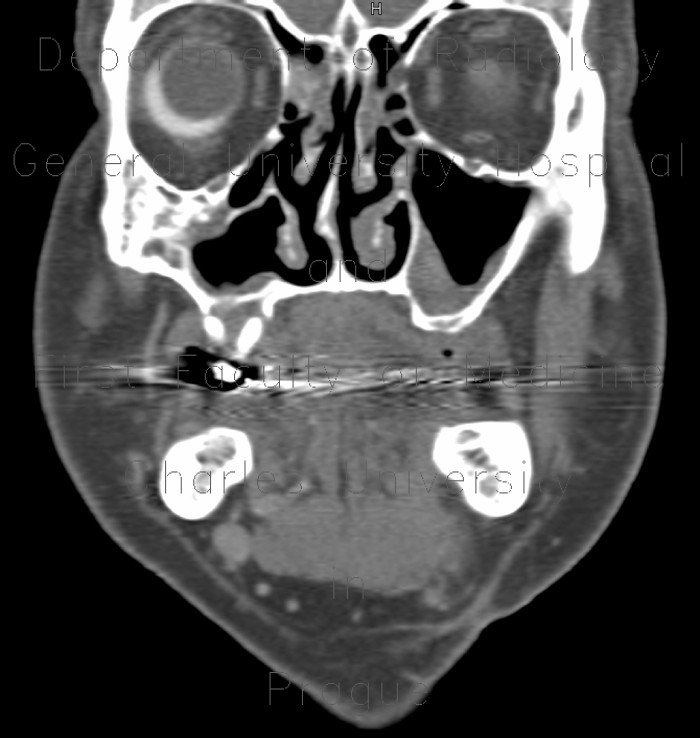 Eyeball, secondary finding, unknown pathology