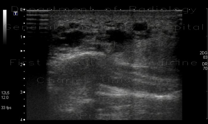 Radiology image - Facial lymphangioma: Head and Neck, Soft tissue: US - Ultrasound