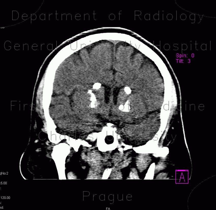 Fahr's disease, morbus Fahr