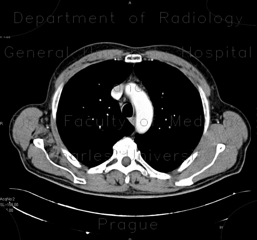 Radiology image - Fatty degeneration of subscapular muscle: Thorax, Soft tissue: CT - Computed tomography