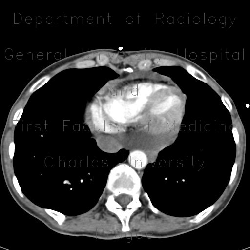Radiology image - Fatty infiltration of the right ventricle, arrhythmogenic right ventricular dysplasia, ARVD: Thorax, Heart: CT - Computed tomography