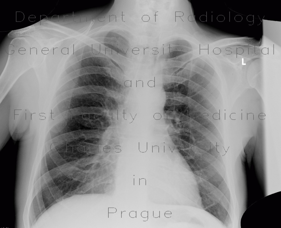 Fenestration of rib