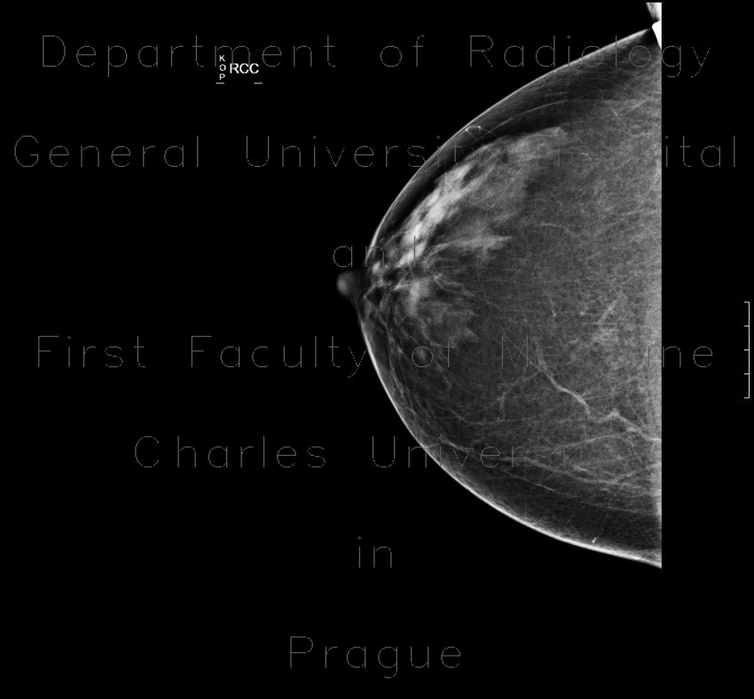 Fibroglandular type of breast, Tabar I